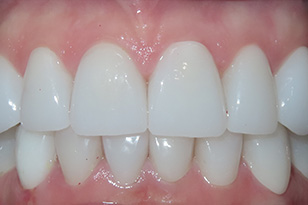 Iconic Dental Arts | Implant Restorations, TMJ Disorders and Same-Day Crowns