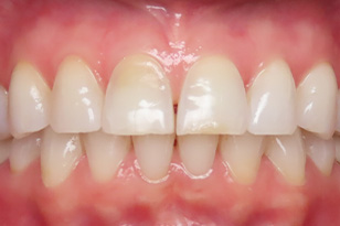 Iconic Dental Arts | All-on-4®, Dental Cleanings and Same-Day Crowns