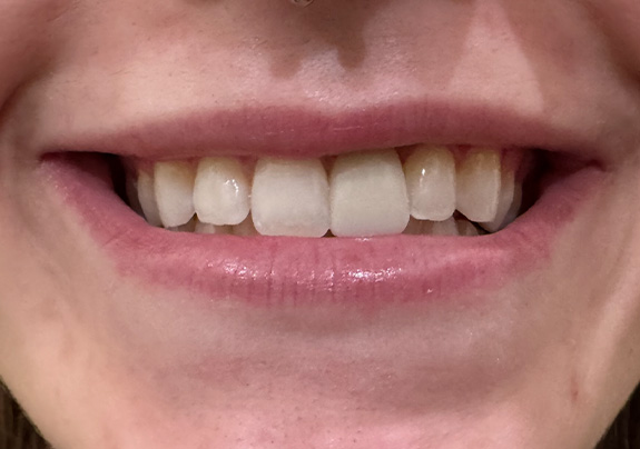 Iconic Dental Arts | Night Guards, Invisalign reg  and All-on-4 reg 