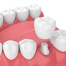 Iconic Dental Arts | Intraoral Camera, Same-Day Crowns and Dental Fillings